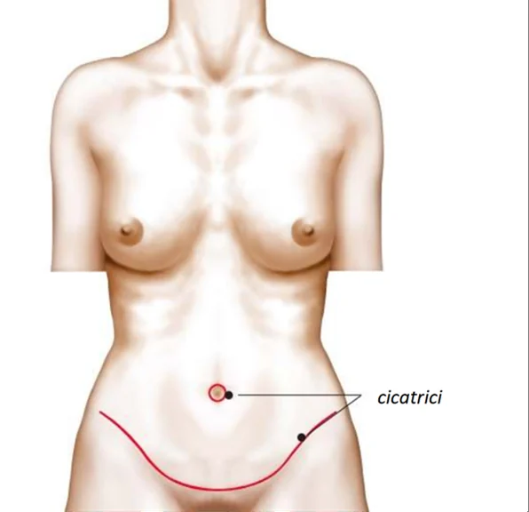 Planșă medicală ilustrativă — abdominoplastie
