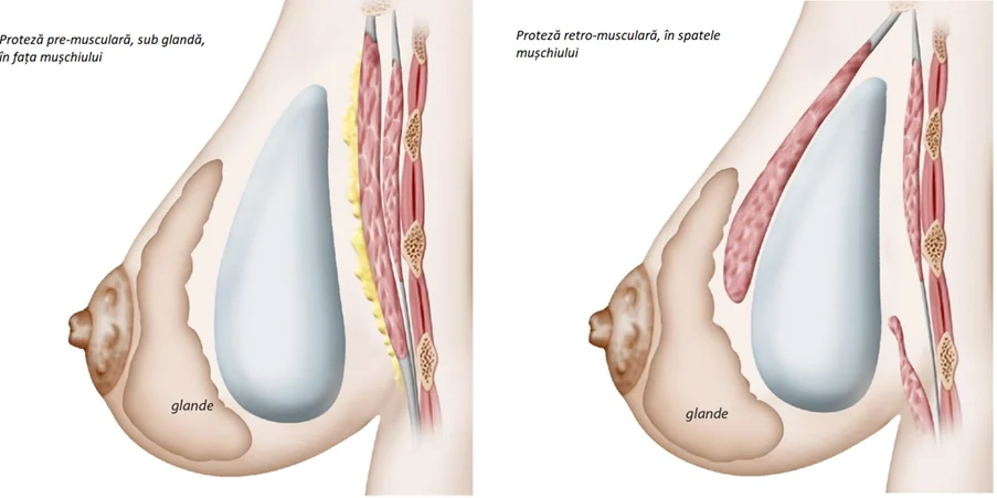 Planșă medicală ilustrativă — augmentare mamară