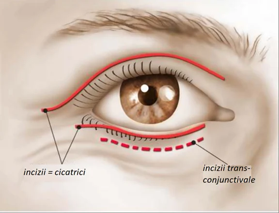 Planșă medicală ilustrativă — blefaroplastie superioară și inferioară