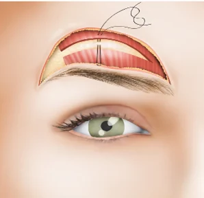 Planșă medicală ilustrativă — lifting cutanat de sprâncene