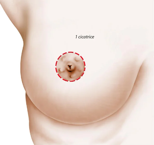 Planșă medicală ilustrativă — mastopexie