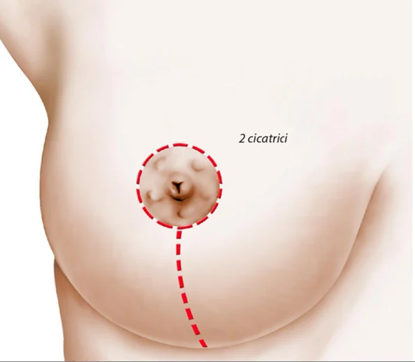 Planșă medicală ilustrativă — mastopexie
