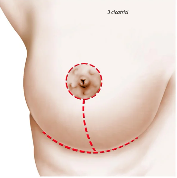 Planșă medicală ilustrativă — mastopexie