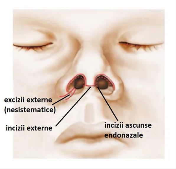 Planșă medicală ilustrativă — rinoplastie estetică